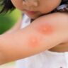 why do mosquitoes bite some people more than others 5edf9e62988ee37b35037ca8